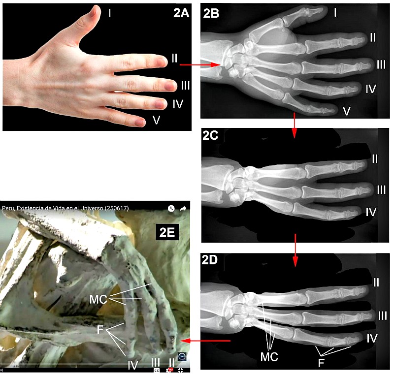 Figura 2. Fuente: Wikimedia. Radiografía de una mano humana (Hellerhoff – CC BY-SA 3.0) y fotografía de una mano humana: (Evan-Amos)