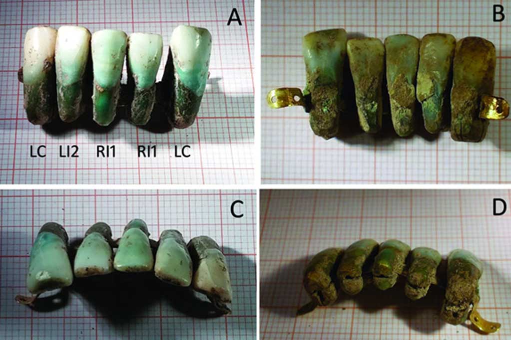 El conjunto de dentaduras postizas medievales descubierto recientemente en Italia. Fotografías: Universidad de Pisa