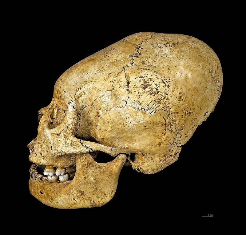 Homo sapiens sapiens – Deformidad craneal provocada intencionadamente (“deformidad peruana”), Cultura Proto-Nazca (200 a. C. – 100 a. C.), región de Nazca, Perú. Museo de Toulouse, Francia. (Didier Descouens/CC BY-SA 4.0)