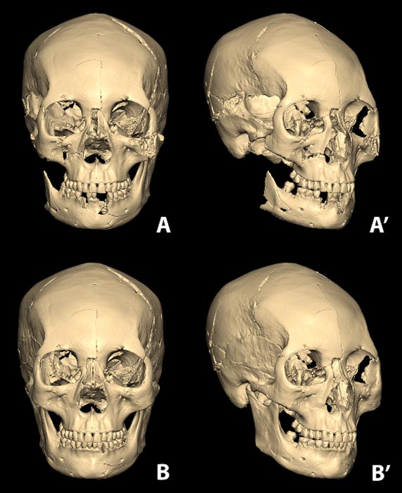 El cráneo elongado de la mujer coreana reconstruido a partir de sus fragmentos óseos utilizando un programa informático de modelado en 3D. (A y A’). Debajo podemos ver la reconstrucción completa del cráneo incluyendo sus partes dañadas o perdidas (B y B’). Imagen: Lee et al., publicada bajo una Licencia Creative Commons.