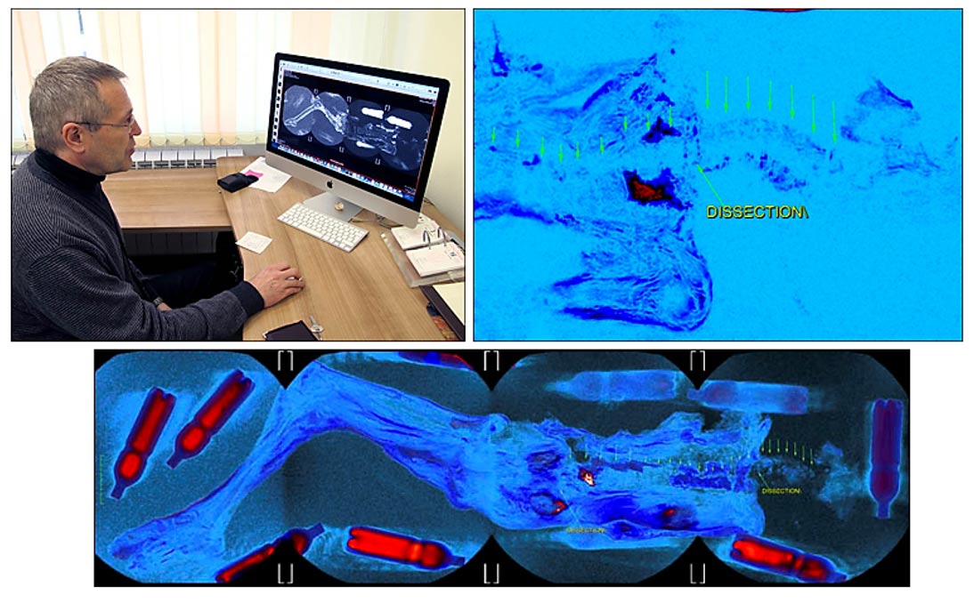 Dr. Andrey Letyagin: ‘Hemos detectado un tumor primario con metástasis en el pecho derecho y los ganglios linfáticos axiales derechos.’ Imágenes: The Siberian Times, Andrey Letyagin