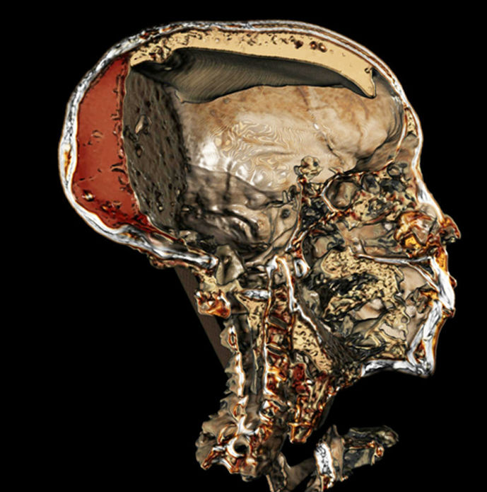 Esta imagen obtenida mediante tomografía computadorizada nos ofrece una sección detallada del cráneo momificado del faraón Tutankamón, en la que se puede apreciar incluso la resina que inyectaron en su cadáver los embalsamadores. (Sahar Saleem)