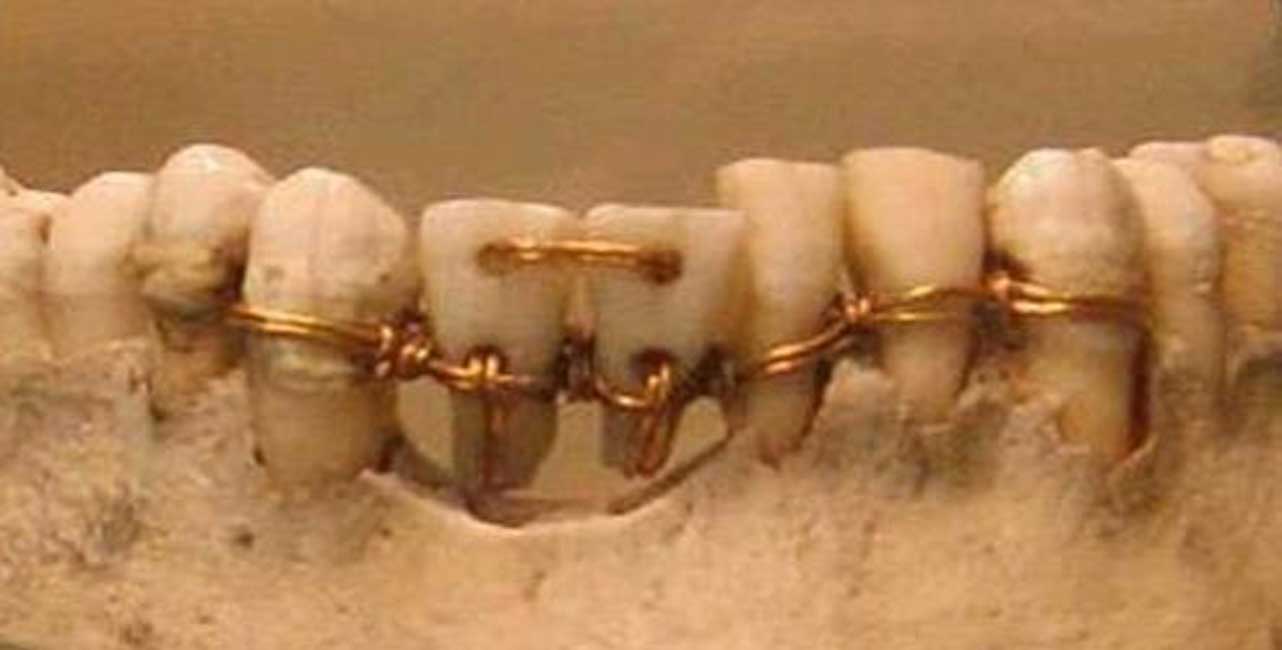 Increíble intervención realizada en la dentadura de una antigua momia. Los dos dientes centrales proceden de donantes.