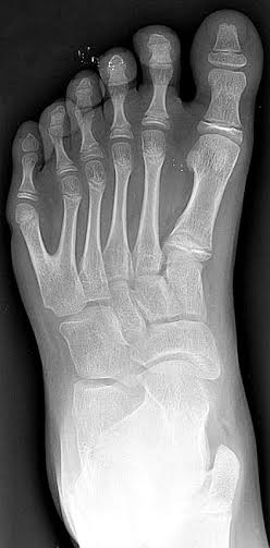 Radiografía de un pie izquierdo con polidactilia. La polidactilia (número anormal de dedos en las extremidades) parece haber sido un patrón habitual entre las razas de gigantes. (Public Domain)