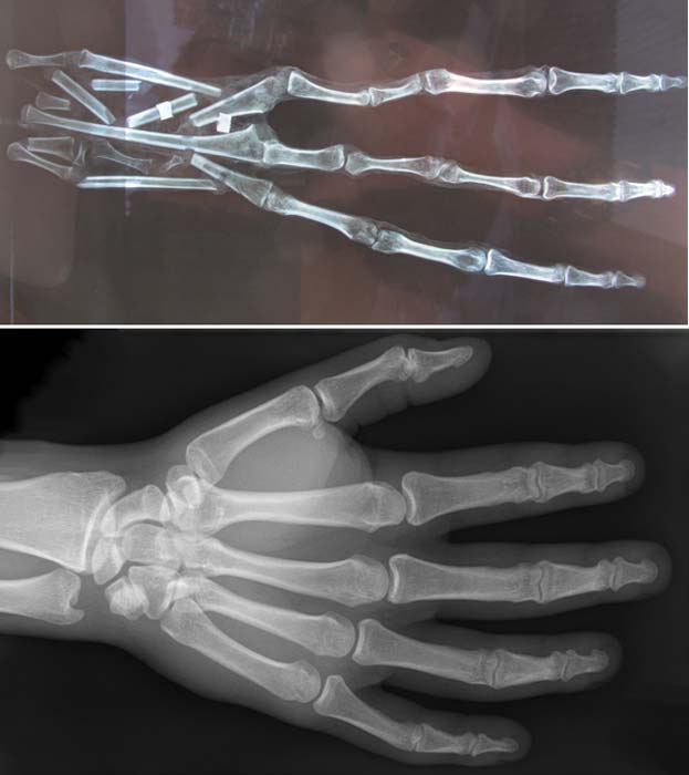 Arriba: la extraña mano momificada descubierta en el desierto peruano vista a través de los rayos X. Se observan 6 huesos en cada dedo (Brien Foerster / Hidden Inca Tours) Abajo: Mano humana vista a través de rayos X. Como podemos ver, en este caso cada dedo tiene únicamente tres huesos. (CC by SA 3.0)