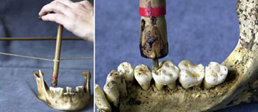 Imágenes en las que se muestra un conocido método utilizado para perforar dientes en épocas antiguas. Se hizo uso de un arco y un taladro con punta de sílex para agujerear los molares recuperados en una necrópolis del Neolítico de Mehrgarh, Paquistán.