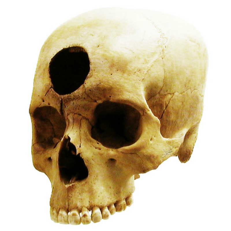 Cráneo perteneciente a la cultura Nazca, de hace alrededor de 2.000 años, que muestra una trepanación frontal, presumiblemente para tratar una inflamación. (Flickr/CC BY-SA 2.0)