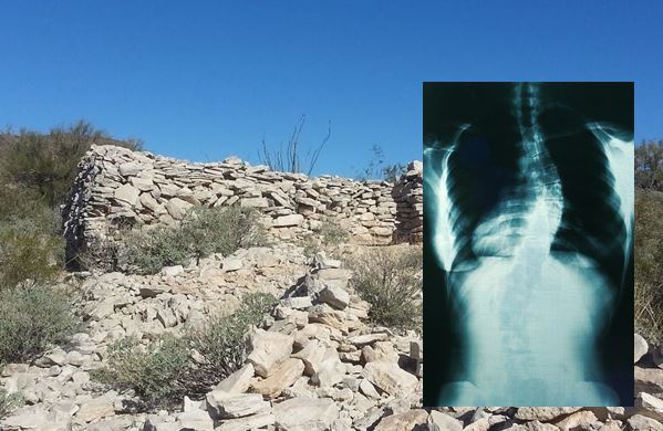 Portada - Ruinas de un asentamiento Hohokam en la cima de Indian Mesa (Public Domain). Detalle: Radiografía de un individuo afectado de escoliosis (Public Domain). 
