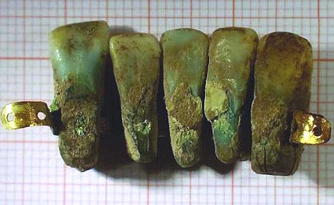 Portada - Prótesis dental medieval descubierta recientemente en Italia. Fotografía: Universidad de pisa.