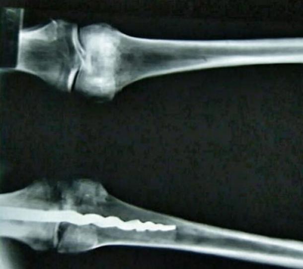 El Misterio Médico De Usermontu: ¿Por Qué El Descubrimiento De Un Tornillo En Una Rótula De 2600 Años Dejó Perplejos A Los Expertos? 9-inch-drill-in-the-knee-mummy