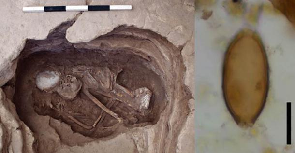 Esqueleto 30928, posible mujer, con edades entre 35 y 50 años, que data del 6700–6500 a.C (Proyecto de investigación Çatalhöyük) Huevo microscópico de látigo de Çatalhöyük, Turquía. La barra de escala negra representa 20 micrómetros. (Evilena Anastasiou)
